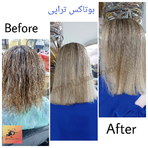 نمونه کار مینا امینی - بوتاکس تراپی